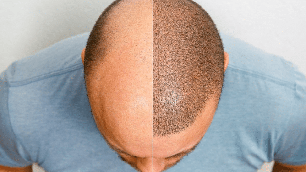 Hair Transplant Cost in Lahore | Cosmetico Plasty