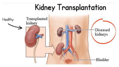 Kidney-Transplant-Cost-in-India-MyMedTrip