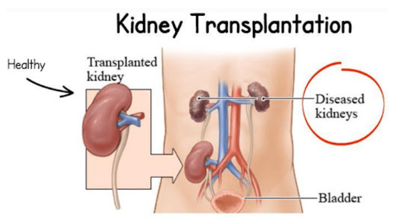 Kidney Transplant Cost in India | MyMedTrip