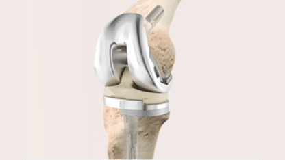 Revision-Joint-Replacement-Surgery-in-Indore-Dr.-Vinay-Tantuway