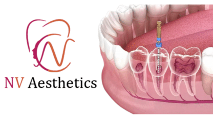 Find The Perfect Root Canal Treatment in Jaipur | NV Aesthetics and Dental Hub