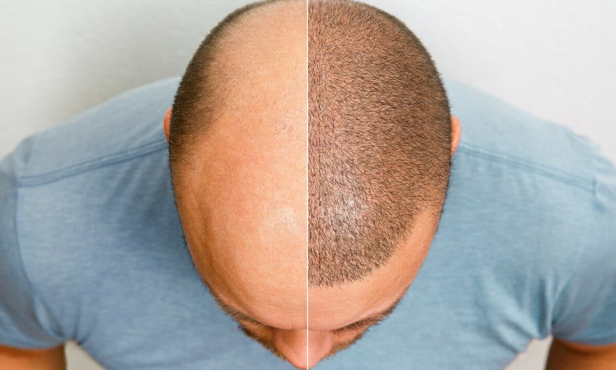Hair Transplant Cost in Lahore | Cosmetico Plasty