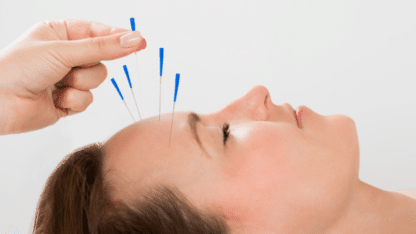 Acupuncture-Treatment-in-London-London-Osteopathy-Pilates