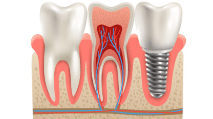 Best-Dental-Implant-in-Mumbai