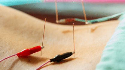 Dry-Needling-Therapy-NYC-Grand-Madison-Acupuncture