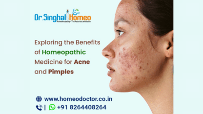 Homeopathic-Medicine-For-Acne-and-Pimples-Dr.-Singhal-Homeo