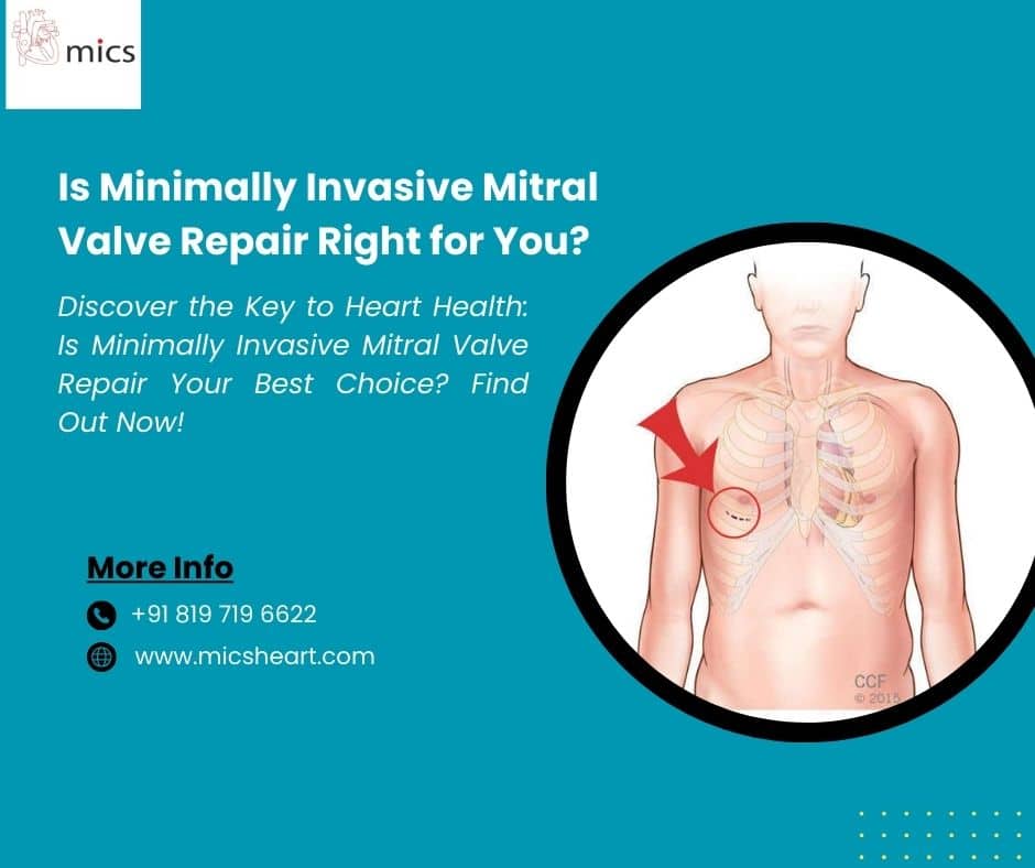Is Minimally Invasive Mitral Valve Repair Right For You?