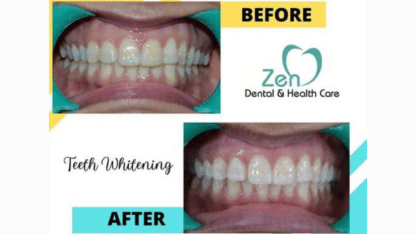 Teeth-Whitening-1.jpg