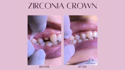 Top-Crowns-and-Bridges-Specialists-For-Repair-in-Sarjapur-Road-Bangalore-Zen-Dental-Care