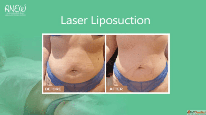Best-Laser-Liposuction-Treatment-in-Bangalore