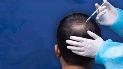 Top-Hair-Fall-and-Baldness-Treatments-Bangalore-Kosmoderma