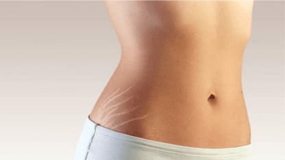 Revolutionize-Your-Skin-Laser-Treatment-For-Stretch-Marks-Removal-in-Chennai