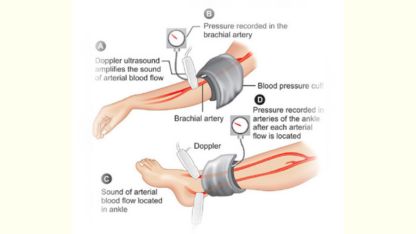 Precise-Arterial-Doppler-Ultrasound-at-Midas-Care-Clinic