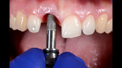 Best-Dental-Implant-Treatment-in-Juhu-Mumbai