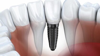 Dental-implants-1024×768@2x