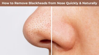 How-to-Remove-Blackheads-from-Nose-Quickly-Naturally