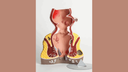 Fistula-in-ANO-Treatment-without-Surgery-in-Lucknow-Navyam-Ayurveda