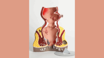 Fistula-in-Ano-Treatment-without-Surgery-Navyam-Ayurveda