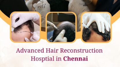 Best-Hair-Transplant-Suregeon-in-Chennai