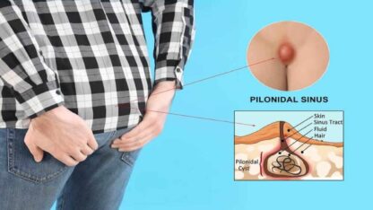 Pilonidal-Cyst-Causes-Symptoms-and-Treatment-Options