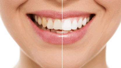 Teeth-Whitening-Before-and-After