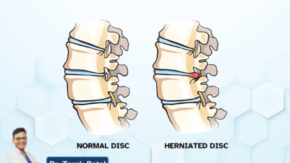 herniated_disc