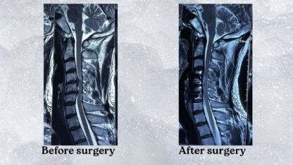 Cervical-Melopathy-Before-and-After-Surgery