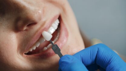 Dental-Implants-Treatment-in-Kukatpally-Banjara-Hills