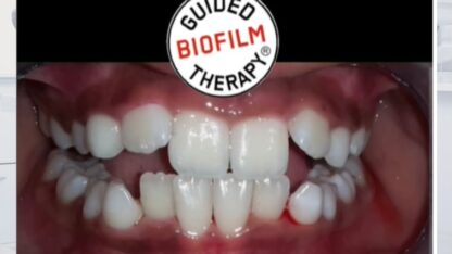 Guided-Biofilm-Therapy-in-Hyderabad-1
