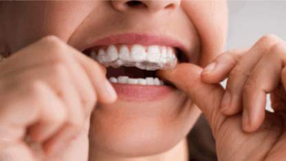 Invisalign-Treatment-In-Vizag-@-The-Dental-Studio-Vizag