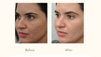 Scar-Revision-Reduction-Tretment-at-Dr-Simple-Aher-Clinic