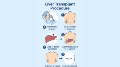 What-is-the-Procedure-for-a-Liver-Transplant