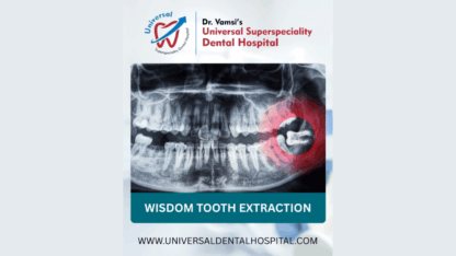 Wisdom-Tooth-Extraction-–-A-Complete-Guide-for-Pain-Free-Recovery