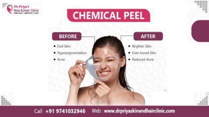 Best-Chemical-Peel-in-Marathahalli-Bangalore-Dr.-Priya-Skin-and-Hair-Clinic