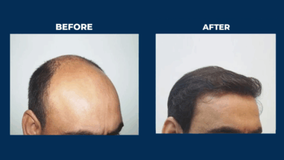 Best-Cosmetic-Surgeon-Hyderabad-Personiks-Skin-Hair-Careucts