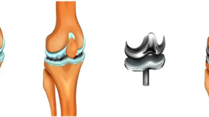 Knee-Replcement-1111