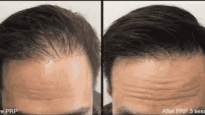 PRP-for-Hairloss-NYC