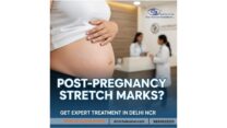 Post-Pregnancy Stretch Marks? Get Expert Treatment in Delhi NCR