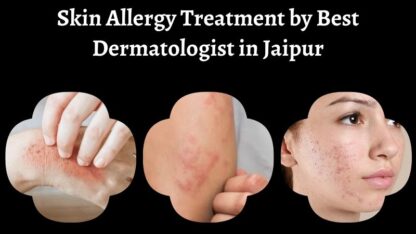 Skin-Allergy-Treatment-by-Best-Dermatologist-in-Jaipur