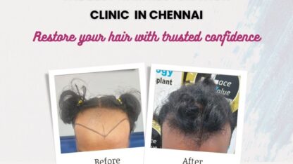 Best-Hair-Treatment-Clinic-in-Chennai-1