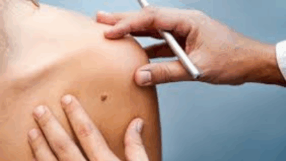 Dermatologist-Orlando-Allergy-Asthma-Center-Skin-check-Acne-Skin-Cancer-Moles