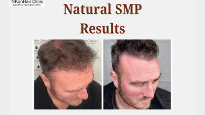 Natural-SMP-Results-–-Realistic-Undetectable-Scalp-Micropigmentation