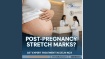 Post-Pregnancy Stretch Marks? Get Expert Treatment in Delhi NCR