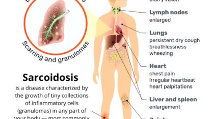 Sarcoidosis-treatment-at-affordable-price-with-top-chest-expert-Dr-sheetu-singh