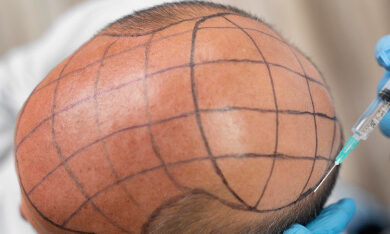 Hairline-reconstruction