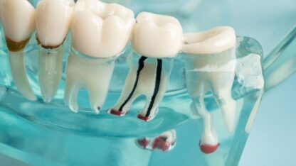 Root-Canal-Treatment-akdental-clinic