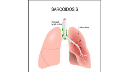 Sarcoidosis-Specialist-in-Jaipur-Rajasthan-Lung-Disease-Expert