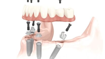 All-On-4-Dental-Implants-San-Diego