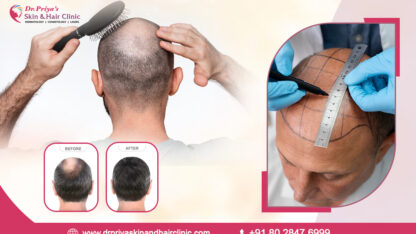 Best-Non-Surgical-Hair-Replacement-In-Marathahalli-Bangalore