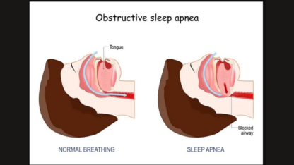 Best-Sleep-Apnea-Doctor-in-Jaipur-Rajasthan-–-Dr.-Virendra-Singh